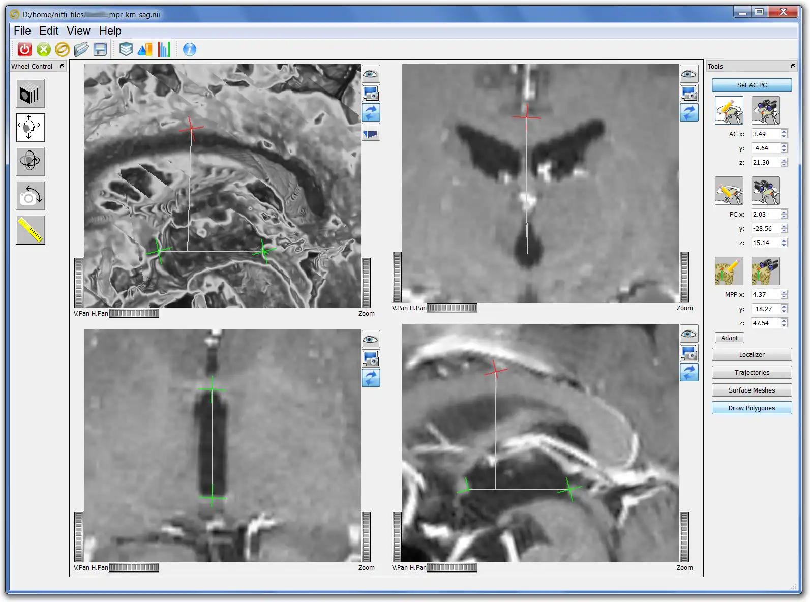 Download web tool or web app Ogles -  OpenGL/OIV  stereotactic tool to run in Windows online over Linux online